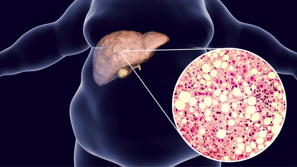 Gordura no fígado | Dr. Octávio Rodrigues | Gastro